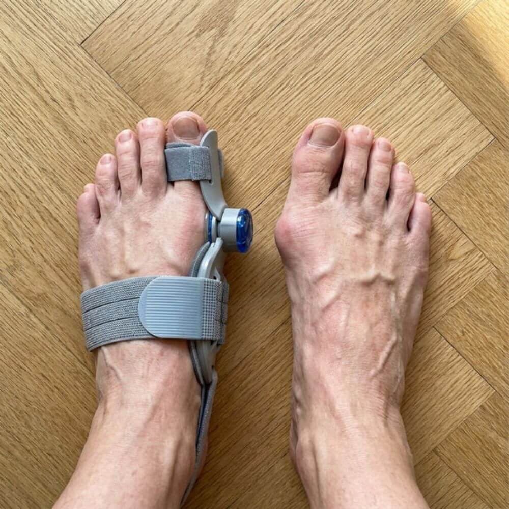 3D Bunion Corrector