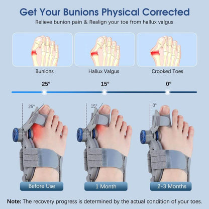 3D Bunion Corrector